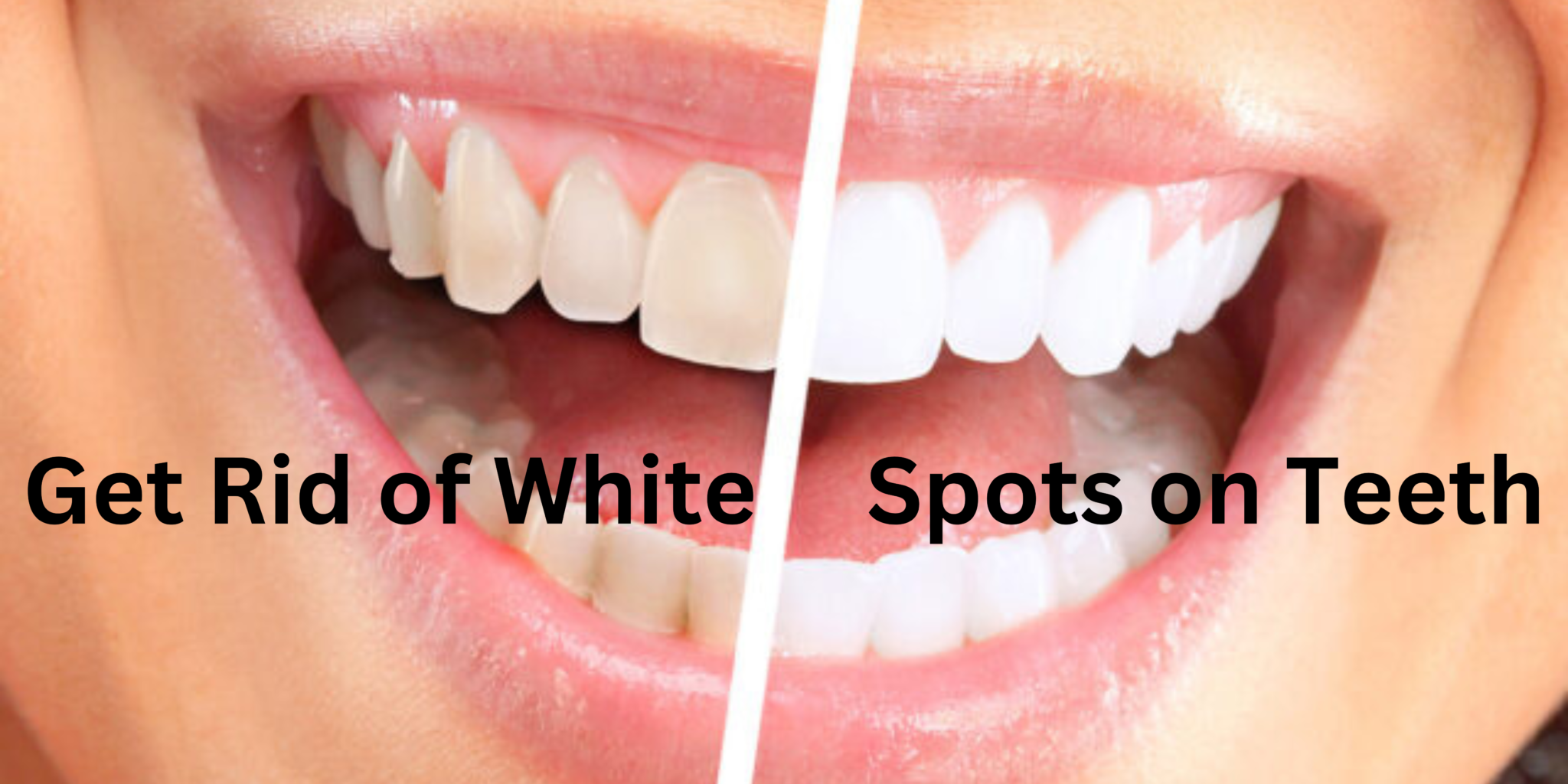 white-spots-on-teeth-how-to-get-rid-of-white-spots-on-teeth