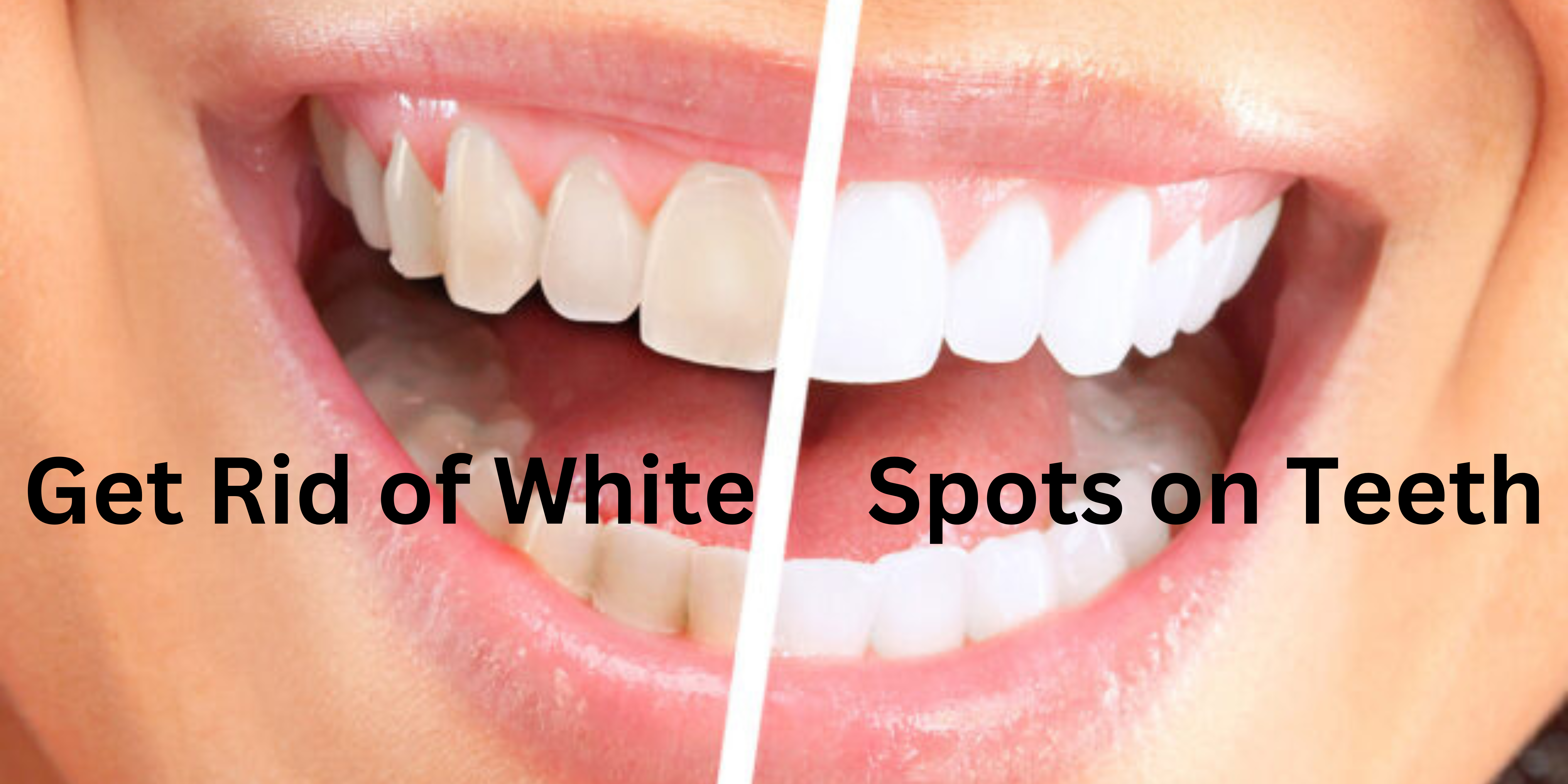 get rid of white spots on teeth